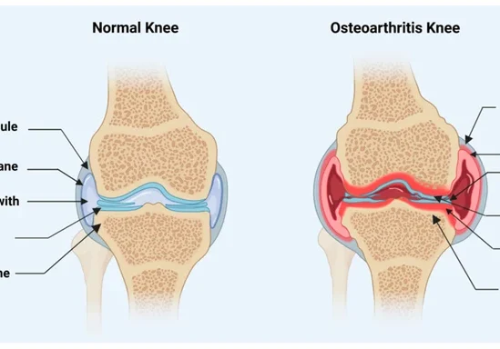 An-illustration-of-a-healthy-knee-joint-compared-to-an-osteoarthritic-knee-Inflammation.webp